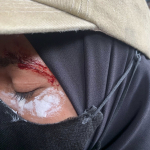 Tampak Salah Satu perserta Aksi mengalami pendarahan di bagian pelipis mata. 