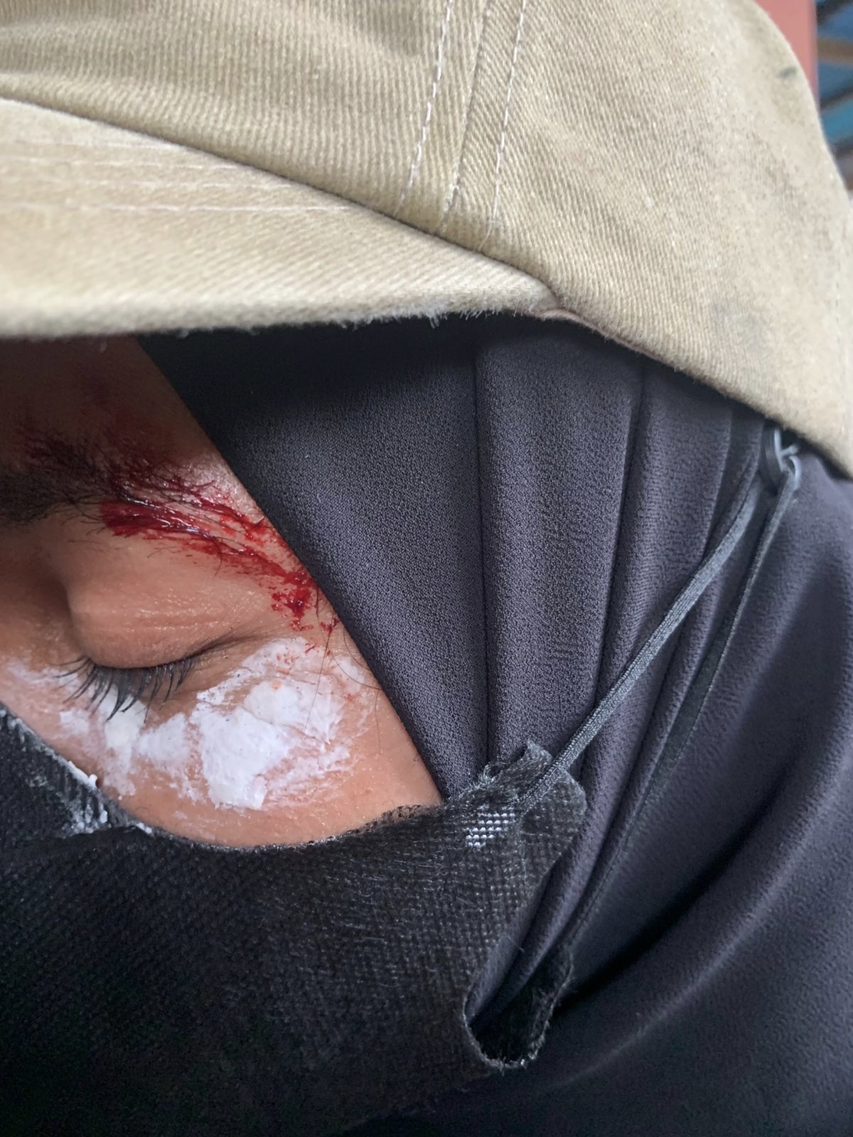 Tampak Salah Satu perserta Aksi mengalami pendarahan di bagian pelipis mata. 